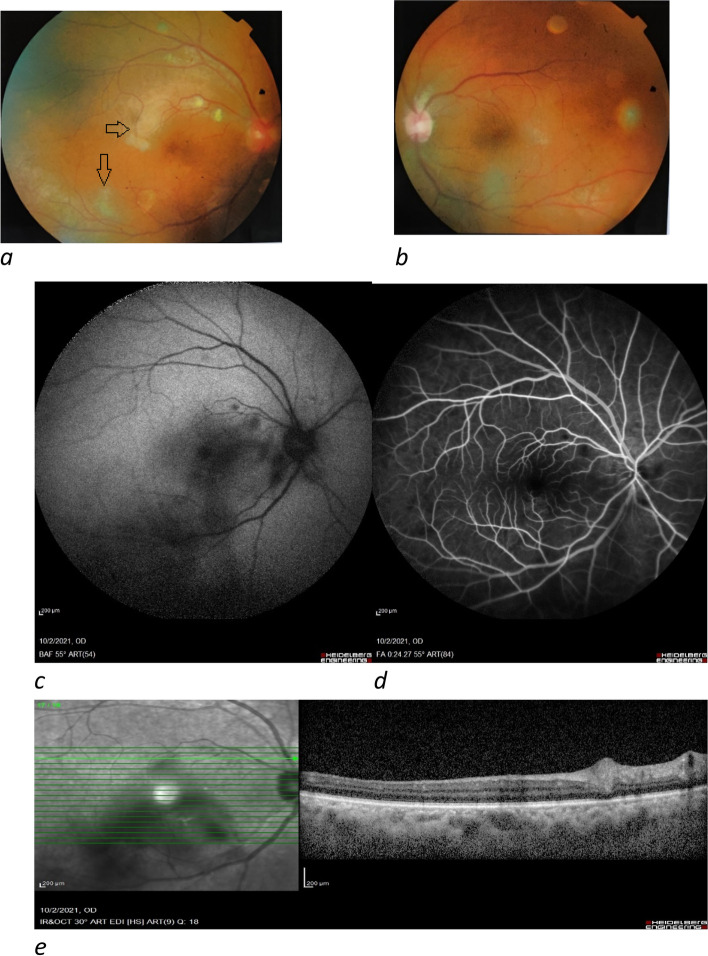 Uveitis including Vogt-Koyanagi-Harada syndrome following inactive covid-19 vaccination: a case series.