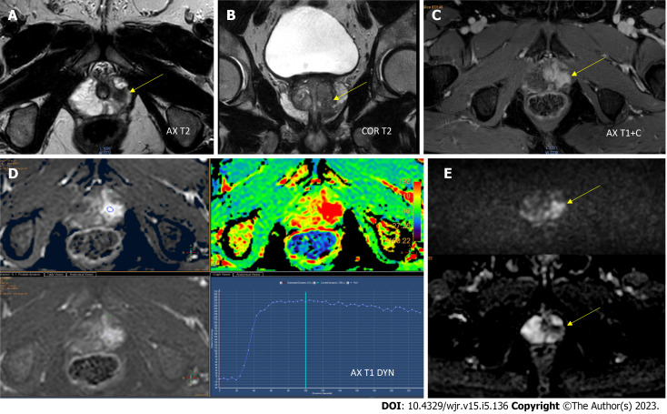 Future of prostate imaging: Artificial intelligence in assessing prostatic magnetic resonance imaging.