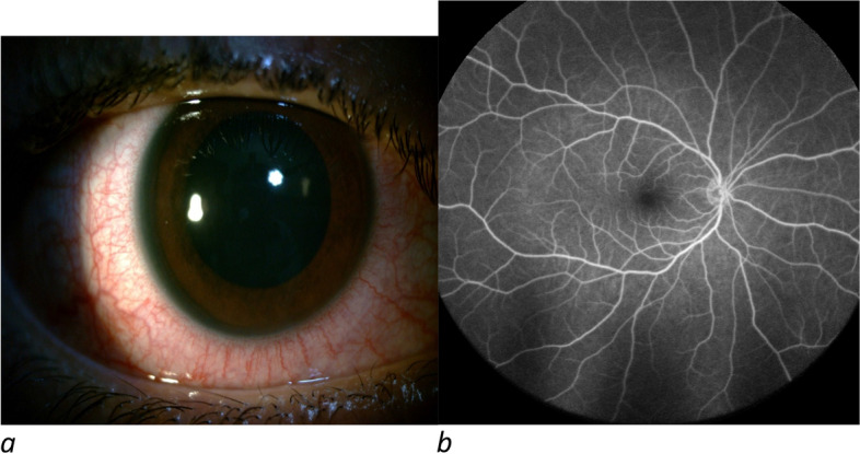 Uveitis including Vogt-Koyanagi-Harada syndrome following inactive covid-19 vaccination: a case series.