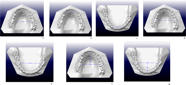 Correlation between dental arch form and OSA severity in adult patients: an observational study.