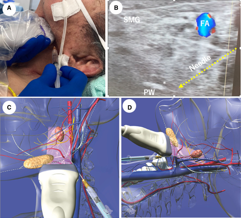 Ultrasound-Guided Glossopharyngeal Nerve Block for an Awake Intubation in a Patient Predicted to Have a Difficult Airway: A Case Report.