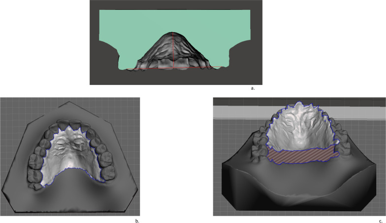 Correlation between dental arch form and OSA severity in adult patients: an observational study.