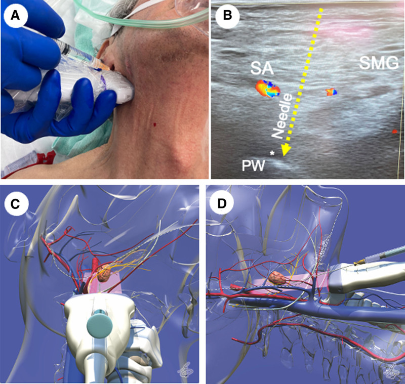 Ultrasound-Guided Glossopharyngeal Nerve Block for an Awake Intubation in a Patient Predicted to Have a Difficult Airway: A Case Report.