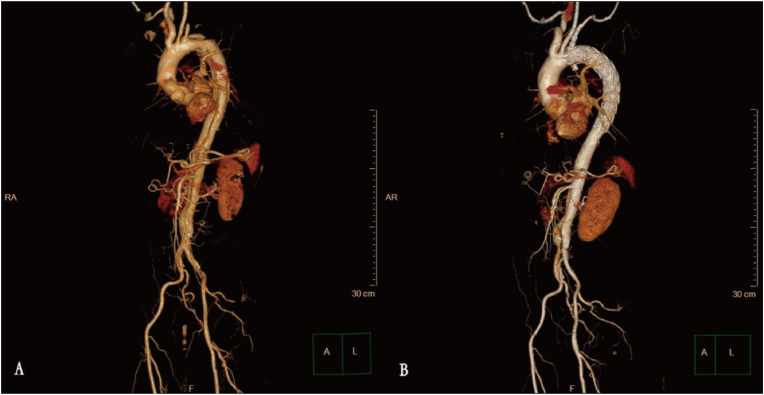 Mid-term outcomes of left subclavian artery revascularization with Castor stent graft in treatment of type B aortic dissection in left subclavian artery