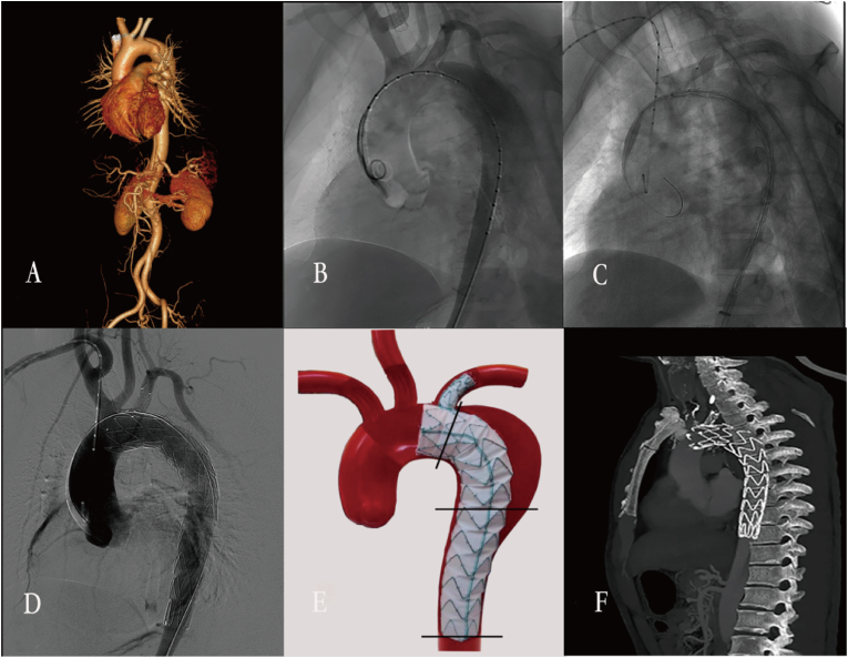 Mid-term outcomes of left subclavian artery revascularization with Castor stent graft in treatment of type B aortic dissection in left subclavian artery