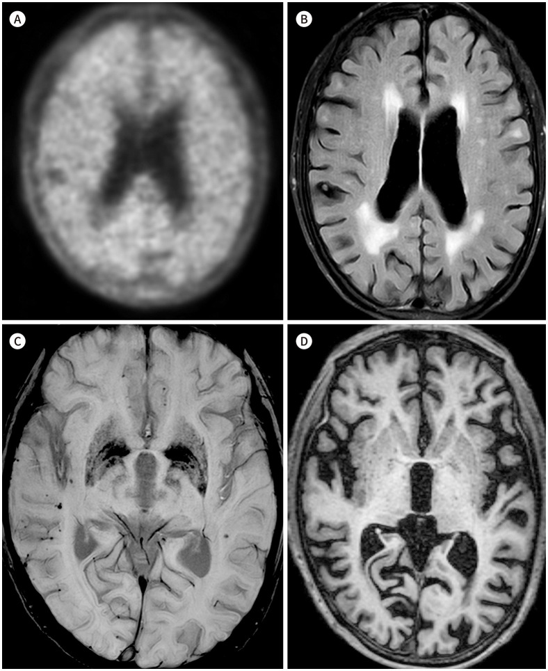 Prediction of Amyloid β-Positivity with both MRI Parameters and Cognitive Function Using Machine Learning.