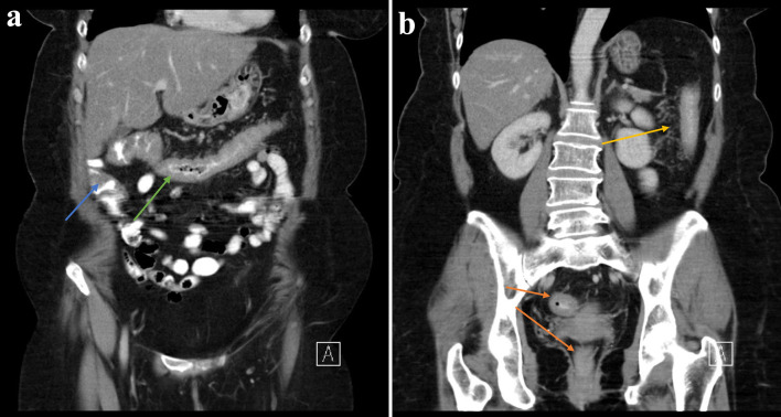 Boon or Bane? Anti-Tumor Necrosis Factor Therapy Complicated by <i>Listeria monocytogenes</i> Meningitis Culminating in Colectomy for Ulcerative Colitis.