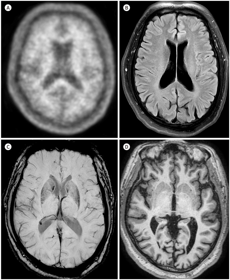 Prediction of Amyloid β-Positivity with both MRI Parameters and Cognitive Function Using Machine Learning.