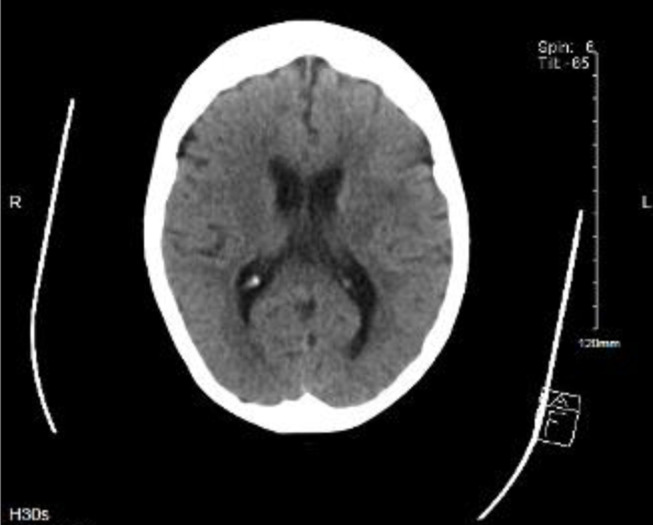 Boon or Bane? Anti-Tumor Necrosis Factor Therapy Complicated by <i>Listeria monocytogenes</i> Meningitis Culminating in Colectomy for Ulcerative Colitis.