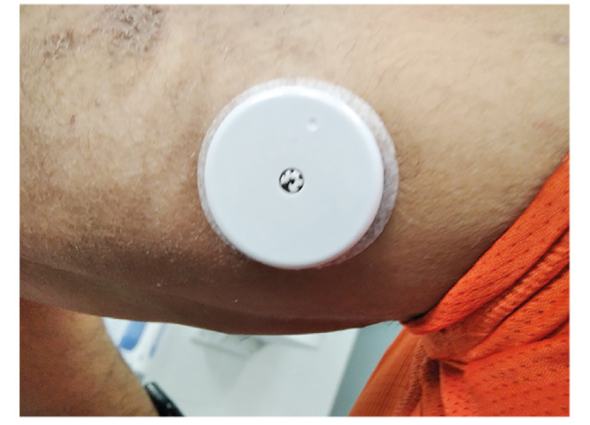 Interstitial glucose monitoring in people with diabetes.