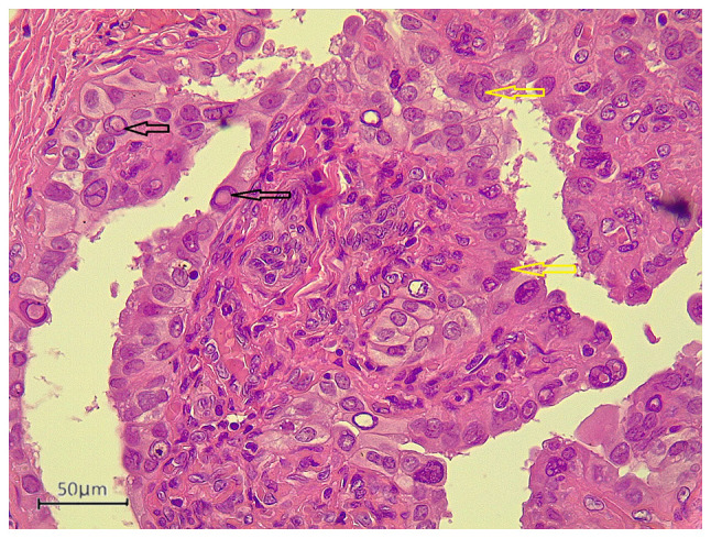 Papillary thyroid carcinoma associated with non‑functioning parathyroid carcinoma with Warthin's tumor of the parotid gland: A case report and brief literature review.