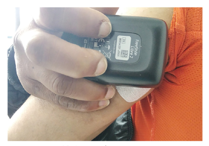 Interstitial glucose monitoring in people with diabetes.