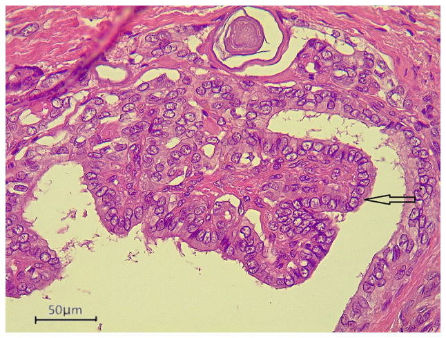 Papillary thyroid carcinoma associated with non‑functioning parathyroid carcinoma with Warthin's tumor of the parotid gland: A case report and brief literature review.