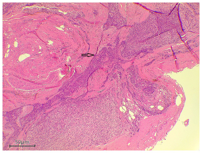 Papillary thyroid carcinoma associated with non‑functioning parathyroid carcinoma with Warthin's tumor of the parotid gland: A case report and brief literature review.