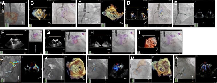 Evolution of interventional imaging in structural heart disease.