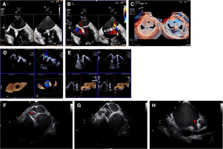 Evolution of interventional imaging in structural heart disease.