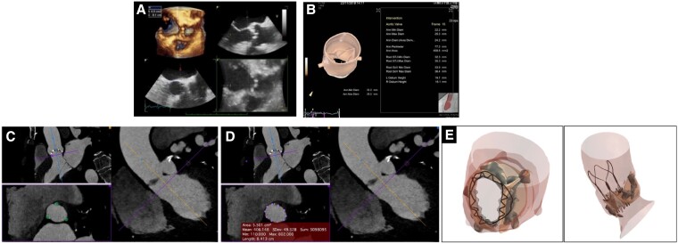 Evolution of interventional imaging in structural heart disease.