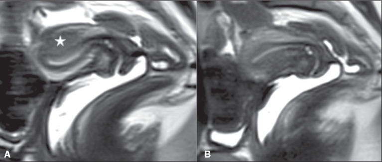 Deep infiltrating endometriosis: cine magnetic resonance imaging in the evaluation of uterine contractility.