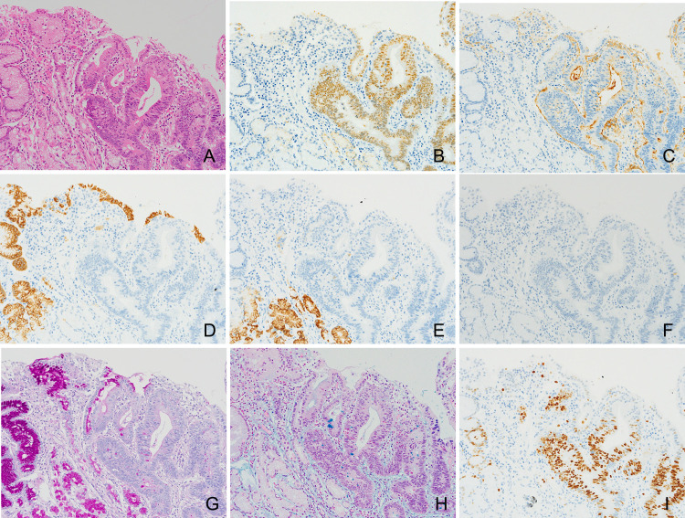 A case of chronic gastric anisakiasis coexisting with early gastric cancer.