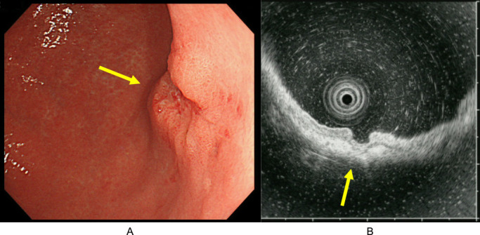 A case of chronic gastric anisakiasis coexisting with early gastric cancer.