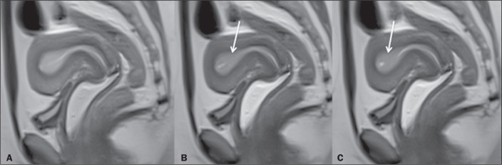 Deep infiltrating endometriosis: cine magnetic resonance imaging in the evaluation of uterine contractility.