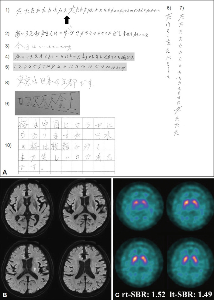 Preservation of Dopamine Transporters in a Patient With Micrographia Due to Cerebral Infarction: A Case Report.