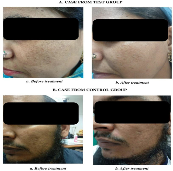 Clinical evaluation of a topical Unani pharmacopoeial formulation <i>Tila-e-Kalf</i> in the management of melasma (<i>Kalf</i>): A randomized controlled clinical trial.