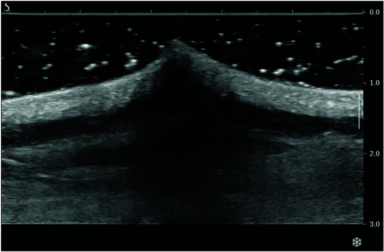 Case Report: Needle Penetrated in the Back Skin Presenting As a Conical Papule.