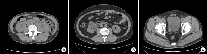 Transfer Learning for Effective Urolithiasis Detection.