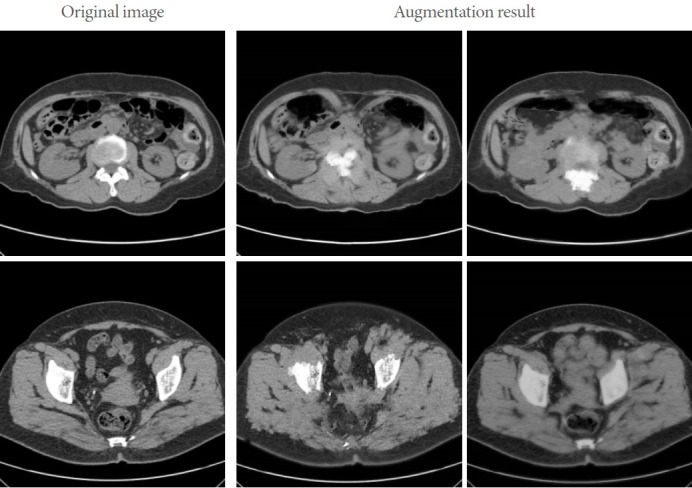 Transfer Learning for Effective Urolithiasis Detection.