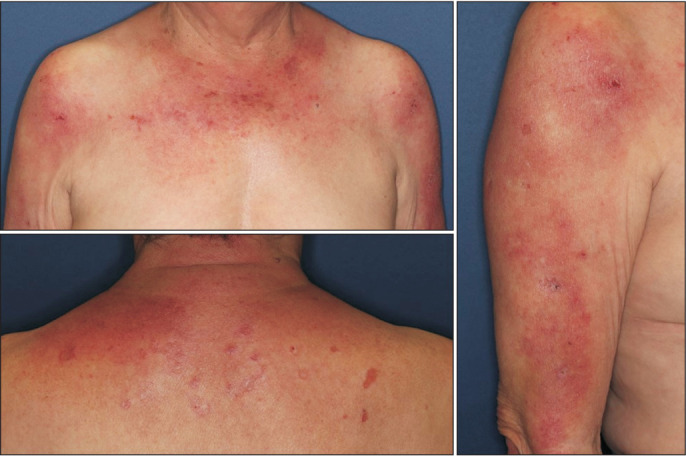 Case of Anti-Small Ubiquitin-Like Modifier Activating Enzyme Antibody-Positive Dermatomyositis with Sarcoidosis.