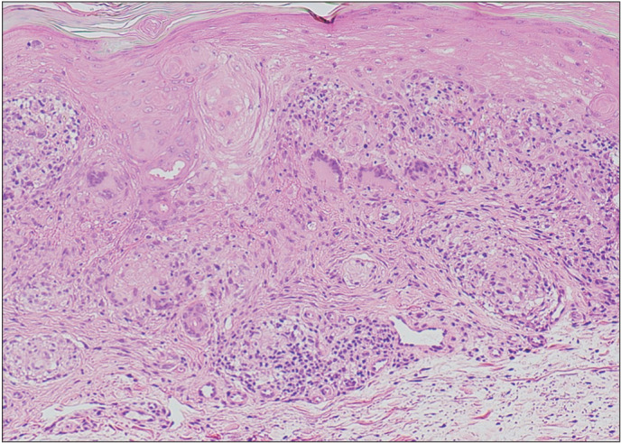 Case of Anti-Small Ubiquitin-Like Modifier Activating Enzyme Antibody-Positive Dermatomyositis with Sarcoidosis.