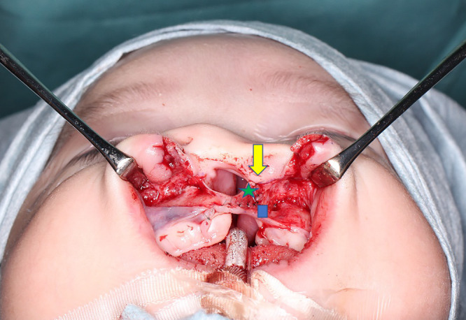 Importance of correcting alar base ptosis during primary cleft lip repair.