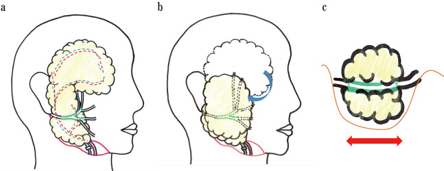 ＜Editors' Choice＞ Long-term outcomes of lateral skull base reconstruction with a free omental flap and facial nerve reconstruction.