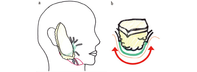 ＜Editors' Choice＞ Long-term outcomes of lateral skull base reconstruction with a free omental flap and facial nerve reconstruction.