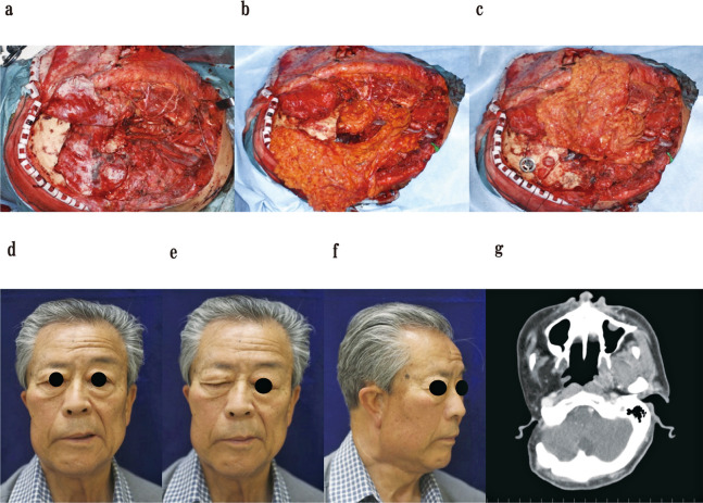 ＜Editors' Choice＞ Long-term outcomes of lateral skull base reconstruction with a free omental flap and facial nerve reconstruction.