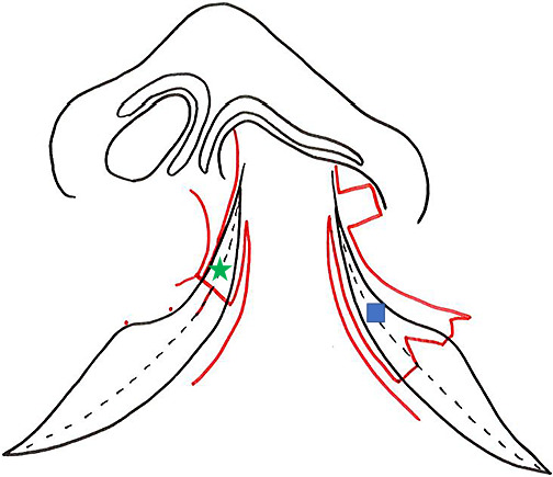 Importance of correcting alar base ptosis during primary cleft lip repair.