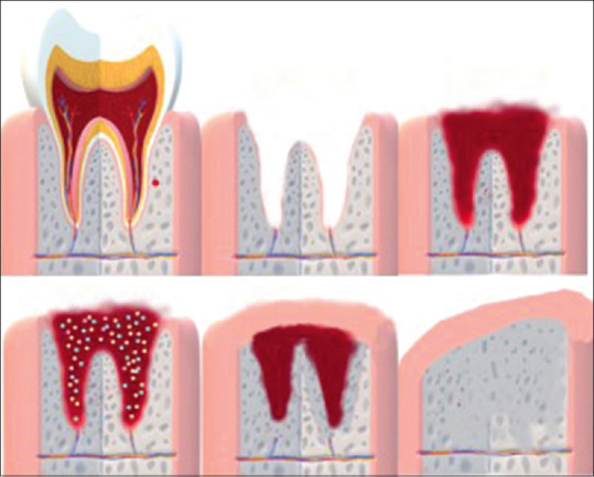 Alveolar ridge preservation: A review of concepts and controversies.