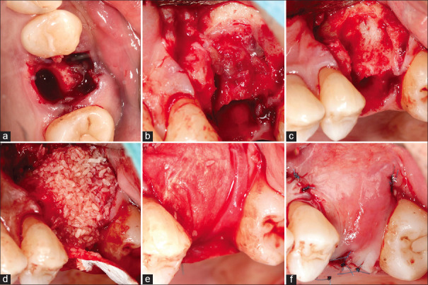 Alveolar ridge preservation: A review of concepts and controversies.