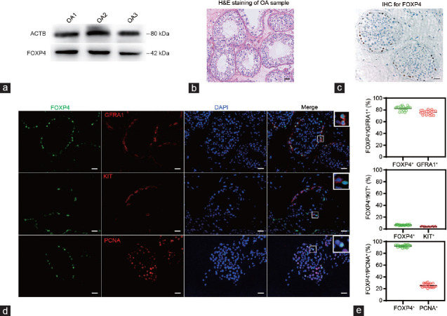 FOXP4 promotes proliferation of human spermatogonial stem cells.