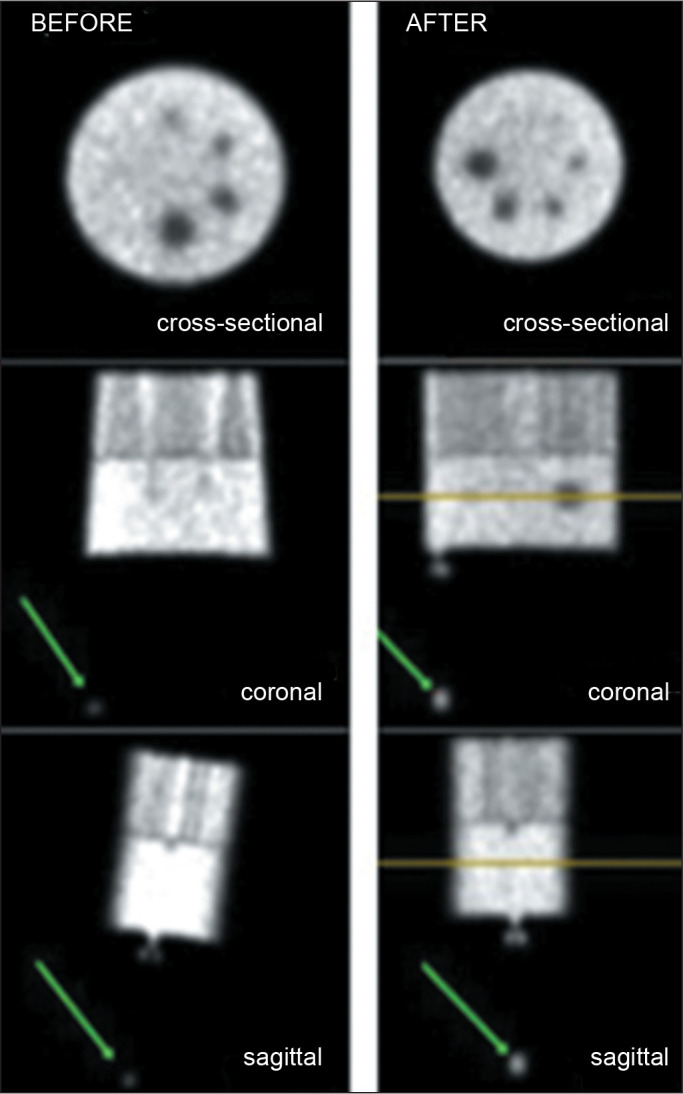 Validation of automated image co-registration integrated into in-house software for voxel-based internal dosimetry on single-photon emission computed tomography images.