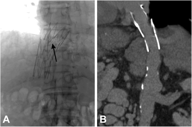 Fracture of inferior vena cava stent after endovascular treatment for Budd-Chiari syndrome: A case series and literature review