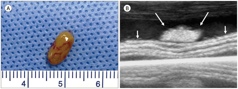 US Features of the Parathyroid Glands: An Intraoperative Surgical Specimen Study.