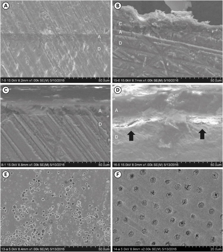 Effect of an aluminum chloride hemostatic agent on the dentin shear bond strength of a universal adhesive.