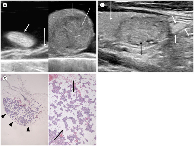 US Features of the Parathyroid Glands: An Intraoperative Surgical Specimen Study.