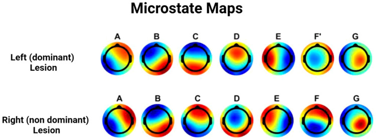 EEG Microstates as a Signature of Hemispheric Lateralization in Stroke.