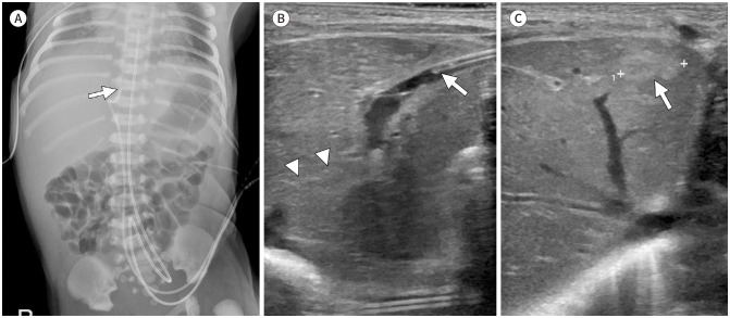 Imaging of Umbilical Venous Catheter-Related Hepatic Complications in Neonates.