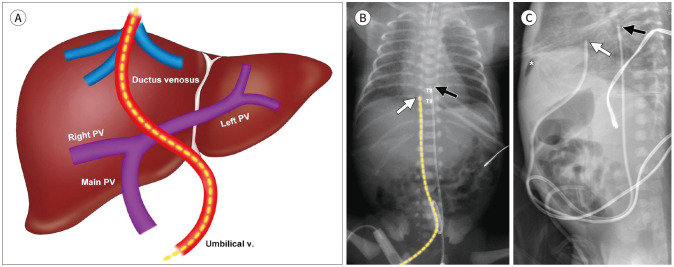 Imaging of Umbilical Venous Catheter-Related Hepatic Complications in Neonates.