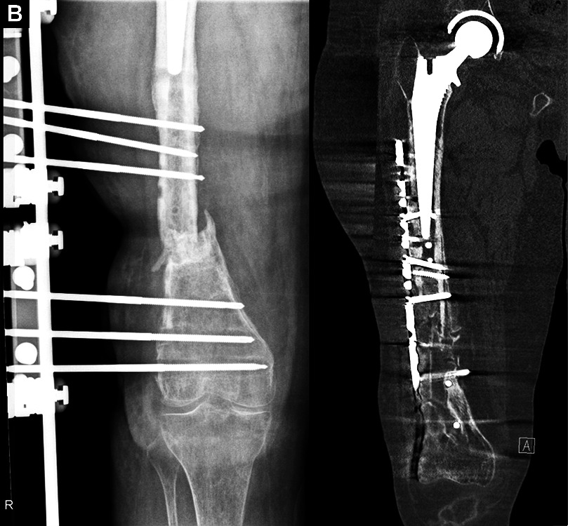 Antimicrobial Mechanisms and Preparation of Antibiotic-impregnated Cement-coated Locking Plates in the Treatment of Infected Non-unions.