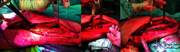 Antimicrobial Mechanisms and Preparation of Antibiotic-impregnated Cement-coated Locking Plates in the Treatment of Infected Non-unions.